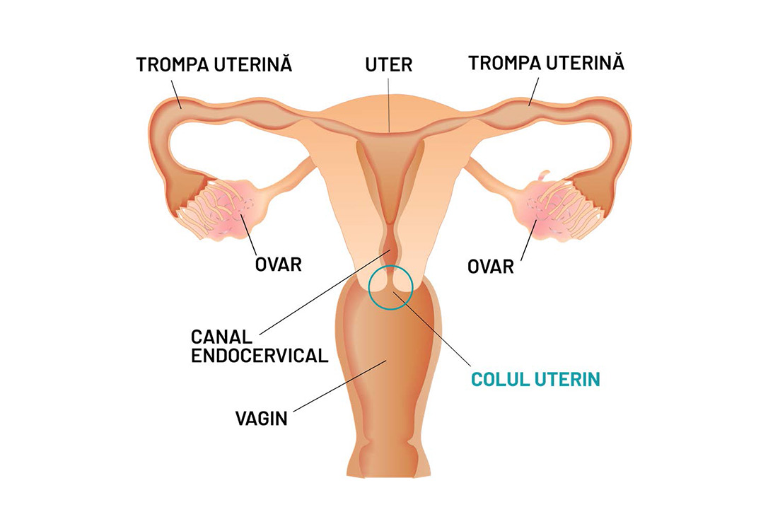ce-este-cancerul-de-col-uterin-oncoprev